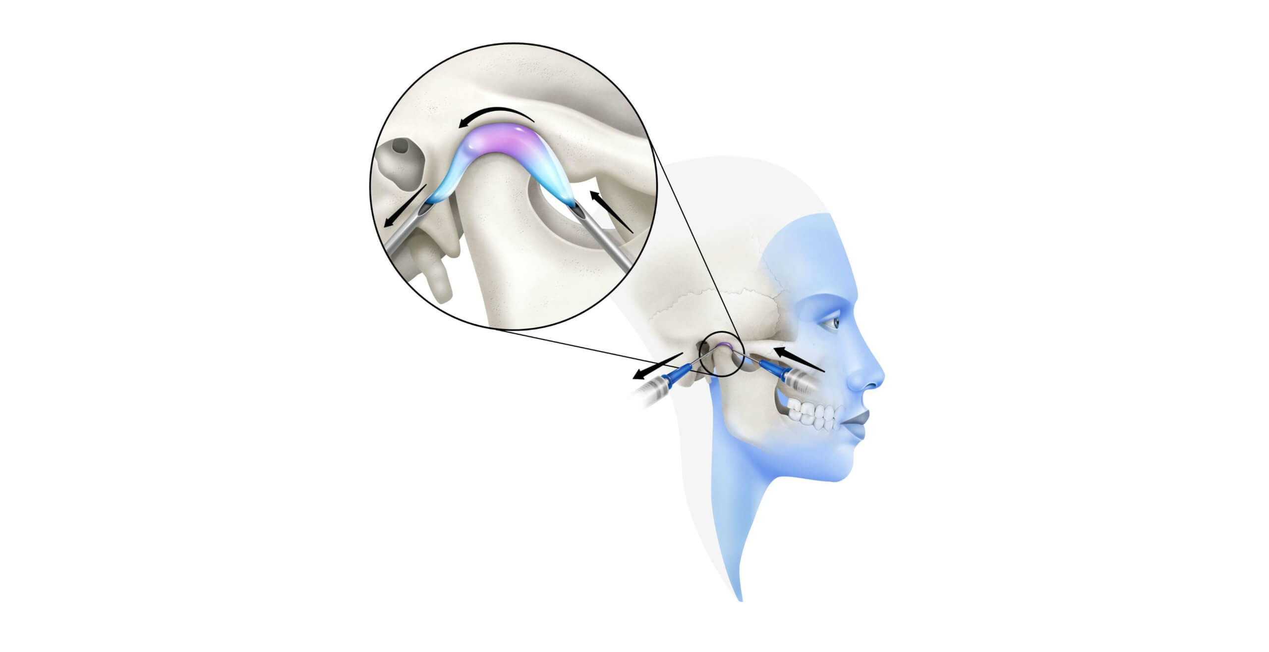 Dolor de ATM: Técnica de la Artrocentésis o lavado de la articulación temporomandibular