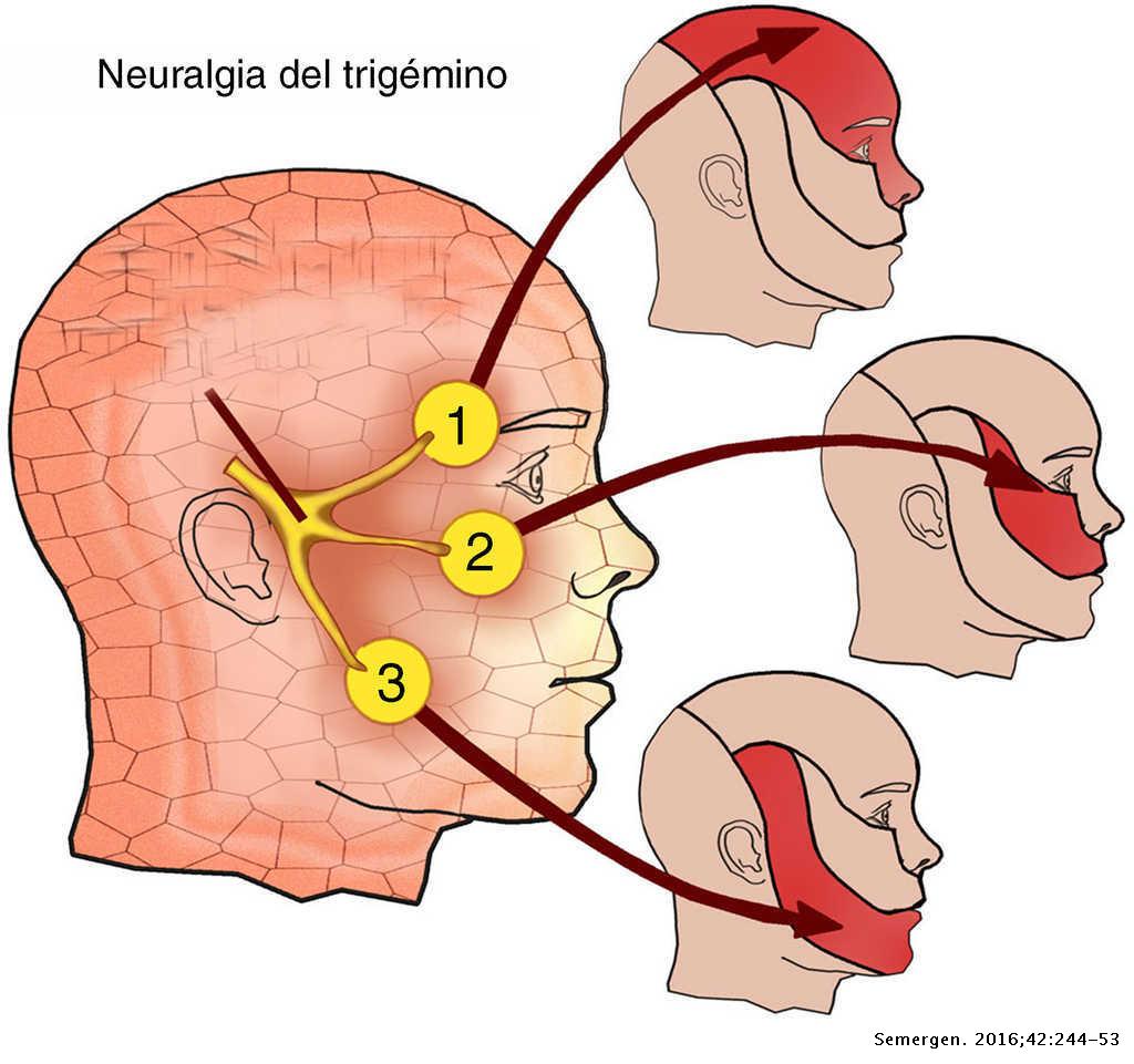 Distribucion de las Ramas del Nervio Trigémino
