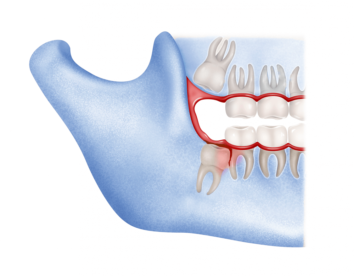 Dr.Cirujano Maxilofacial Guillermo Schoendorff: ¿Cuándo hacer las extracciones de las muelas del juicio?