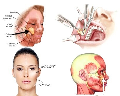 Diagnóstico para una&nbsp;Bichectomía