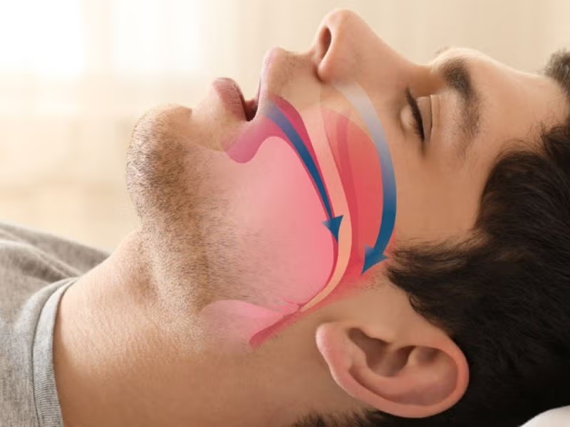 Avances Clínicos y Tecnológicos en el Uso de Dispositivos de Avance Mandibular (DAM) para el Tratamiento del SAHOS: Una Revisión Exhaustiva